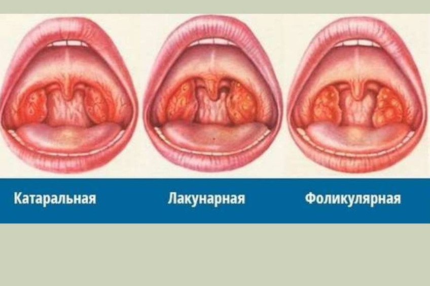 Три распространённых типа ангин