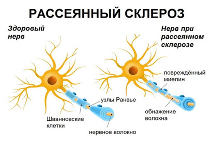 состояние нейрона при рассеянном склерозе