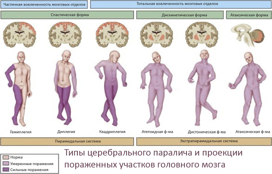 Проявления параличей и отделы мозга