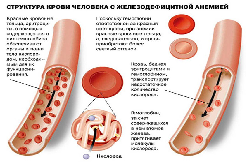 Структура крови человека с железодефицитной анемией