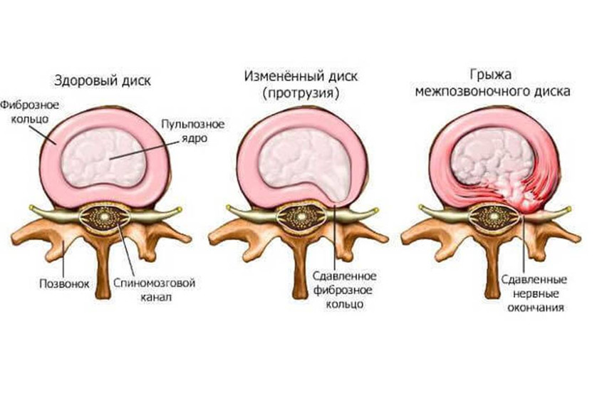 Диск здоровый и повреждённый